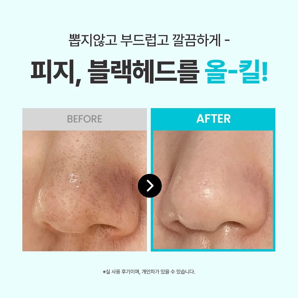 ❰ilso❱ 黑頭 粉刺 導出液 Super Melting Sebum Softener | 深層 潔淨 黑頭鏟 Deep Clean Master (Blackhead Remover)